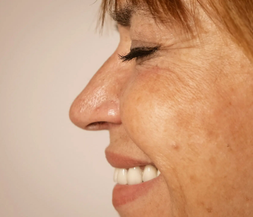 Iabichino Estetica - Protocolli di biostimulazione e bioristrutturazione